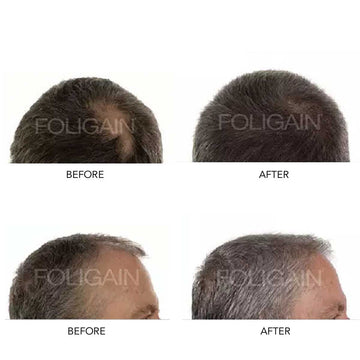 Dua pasangan foto sebelum dan selepas yang menunjukkan ubun-ubun dan garis rambut.