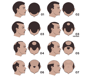 Rajah skala Hamilton-Norwood yang menunjukkan tahap 1 hingga 7 keguguran rambut pola lelaki.