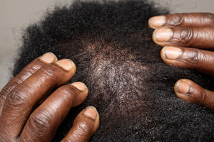 Essential Conditioners for Thinning Hair with TRIOXIDIL®