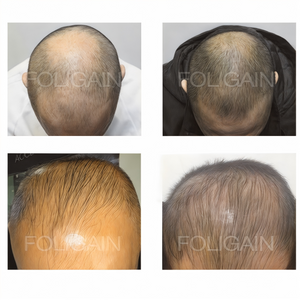 Empat foto sebelum dan selepas yang membandingkan litupan rambut pada kulit kepala yang mengalami penipisan rambut