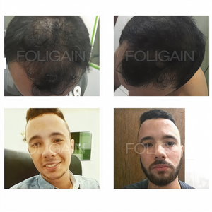 Foto sebelum dan selepas yang membandingkan litupan rambut pada kulit kepala dan bulu muka