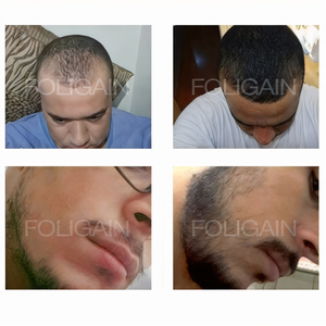 Foto sebelum dan selepas yang membandingkan litupan rambut pada garis rambut dan pipi