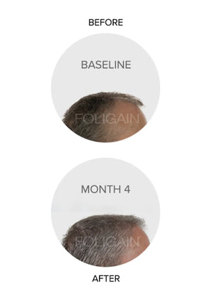 Foto perbandingan klinikal garis rambut yang mula beruban pada awal kajian dan bulan 4